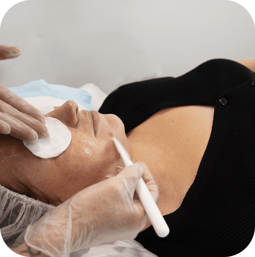 Microneedling for Hair Growth